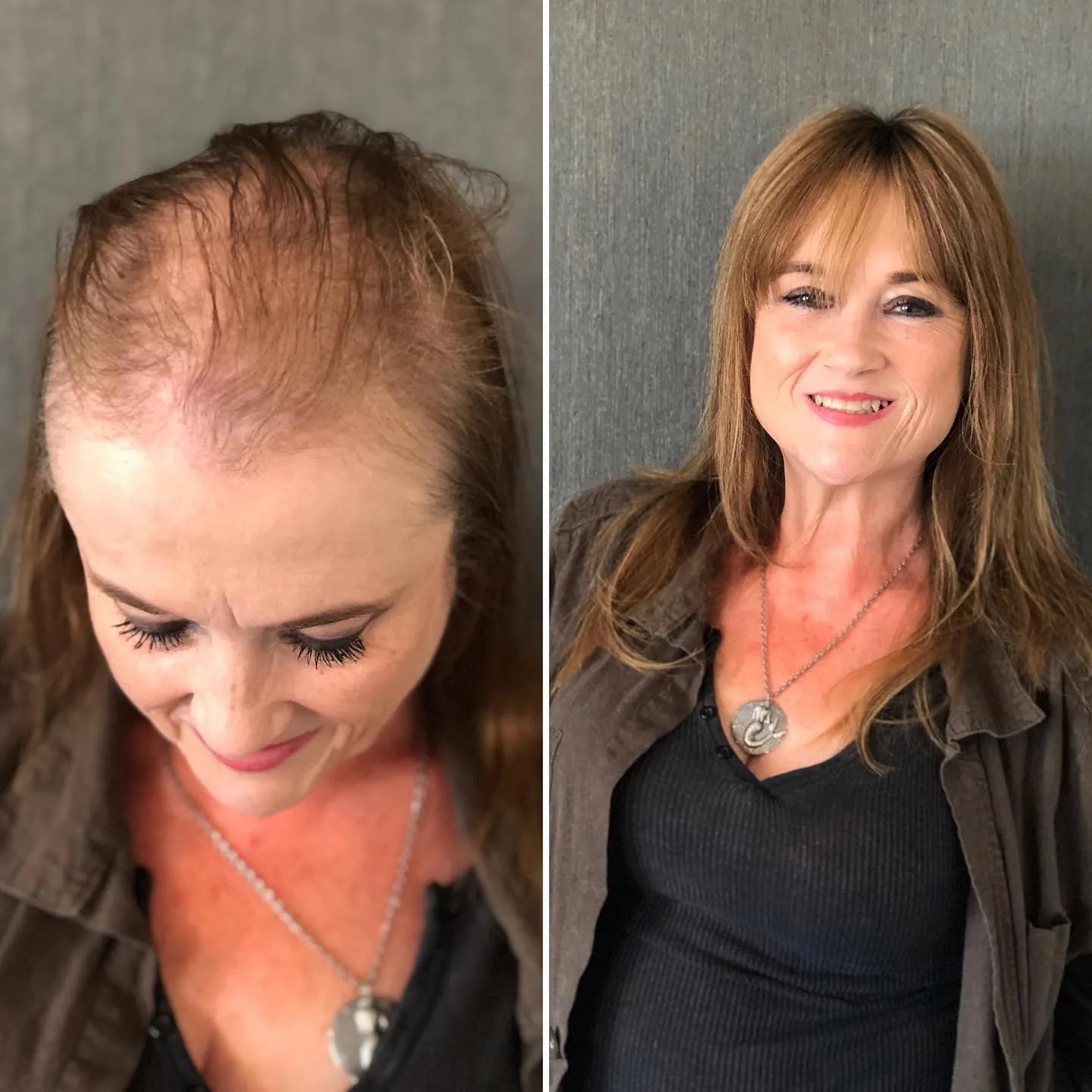 The Transformative Power of Medical Wigs: Before & After Confidence
