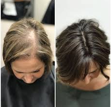 Can Weight Loss Drugs Cause Hair Loss? Here’s What You Need to Know